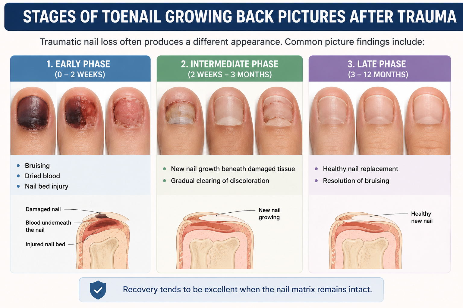 Stages Of Toenail Growing Back Pictures Doctor s Nail Regrowth stages-of-toenail-growing-back-pictures-doctor-s-nail-regrowth